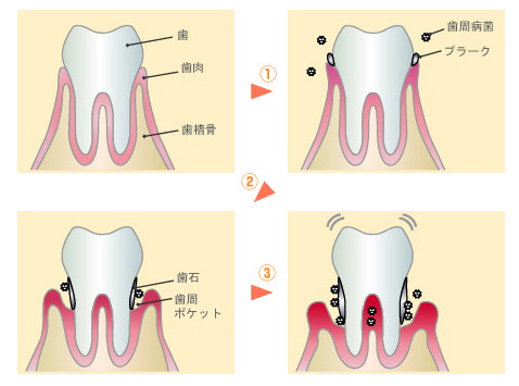 歯周病の進行
